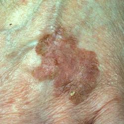 Example of skinCancer